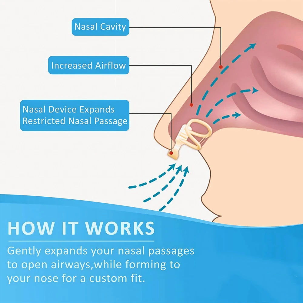 Diagram showing how a nasal device expands nasal passages